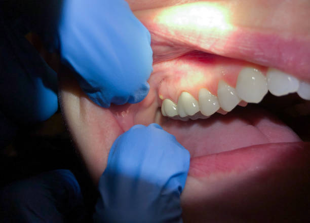 Best Emergency Wisdom Teeth Removal in Lake Zurich, IL